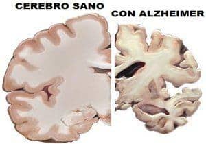 Alzheimer: causas, diagnóstico y tratamiento
