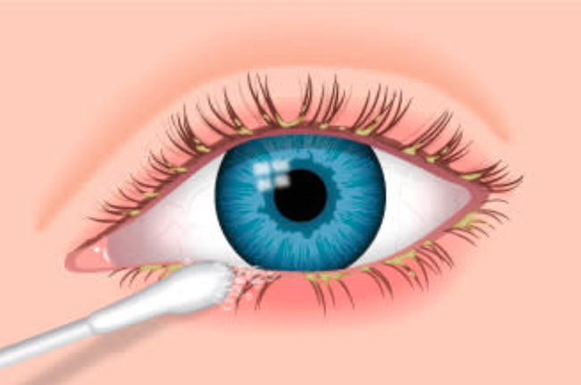 De la Blefaritis al Orzuelo: Qué son, síntomas y tratamientos 2