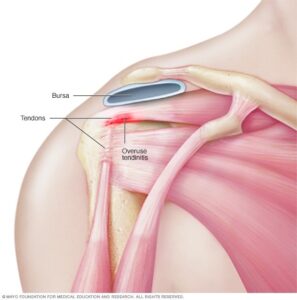 Tendinitis vs bursitis