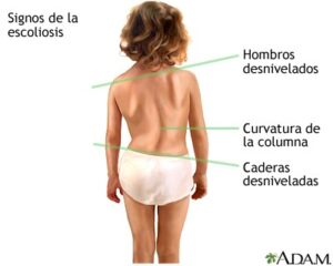 Todo sobre la escoliosis 1