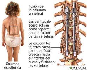 Todo sobre la escoliosis II 1