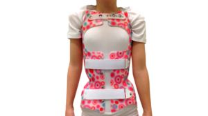 Todo sobre la escoliosis II